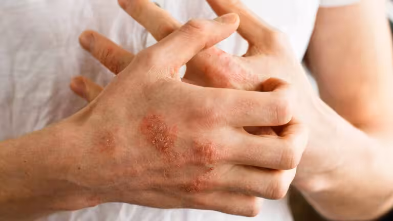 Se aprueba nueva terapia que mejorará la vida de pacientes con Psoriasis Pustulosa Generalizada en México