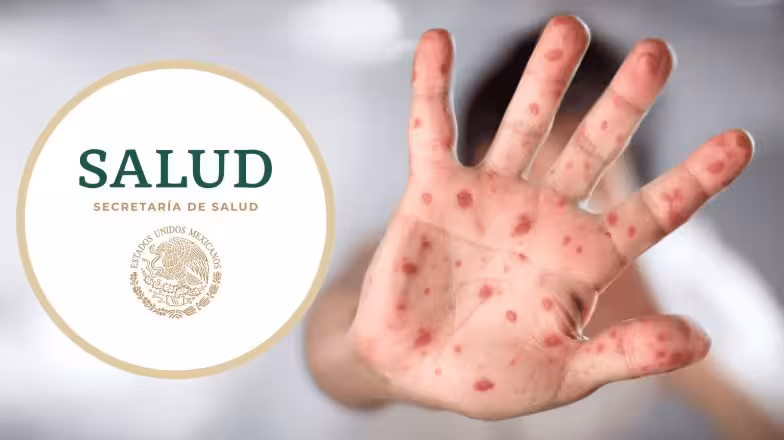 Salud emite nuevo aviso epidemiológico por más casos de sarampión y llama a padres de familia a vacunar a sus hijos