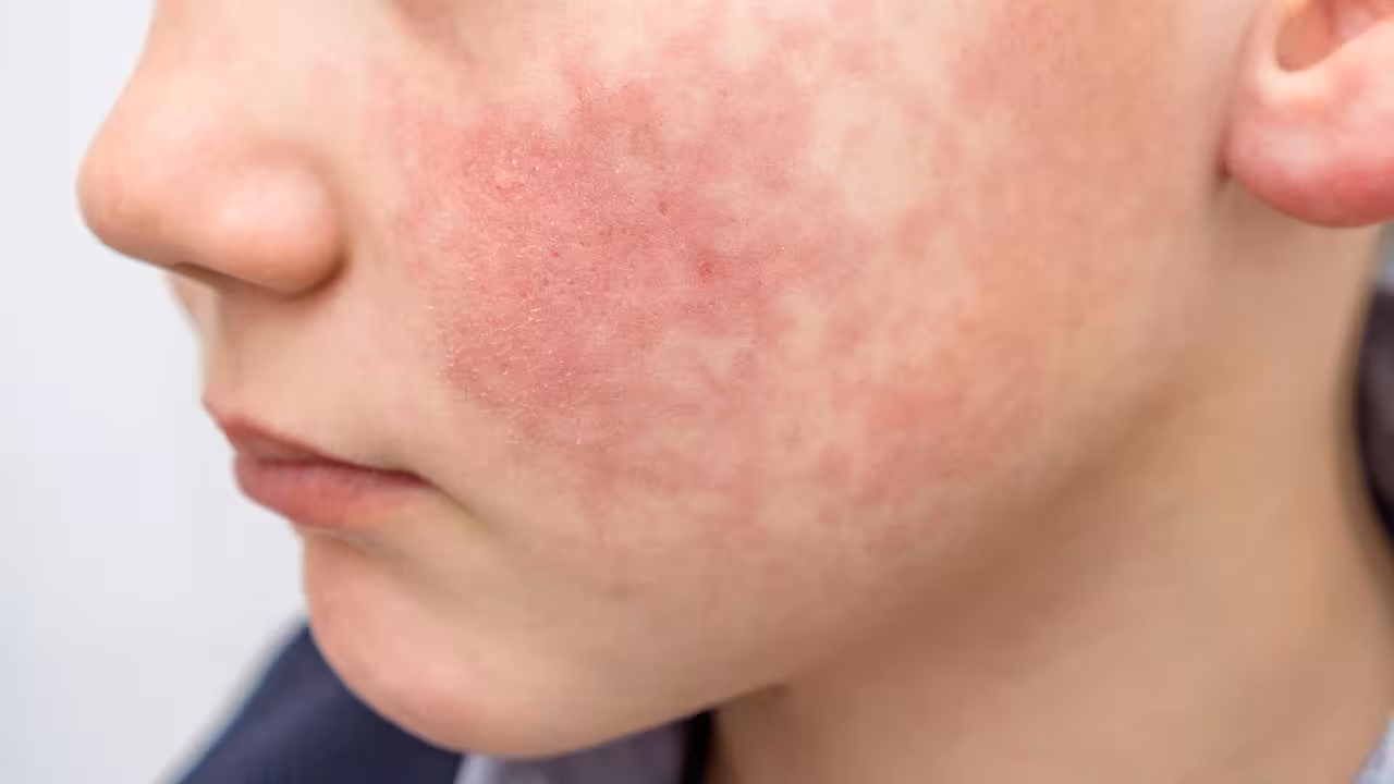 Alertan por aumento en casos de parvovirus humano B19