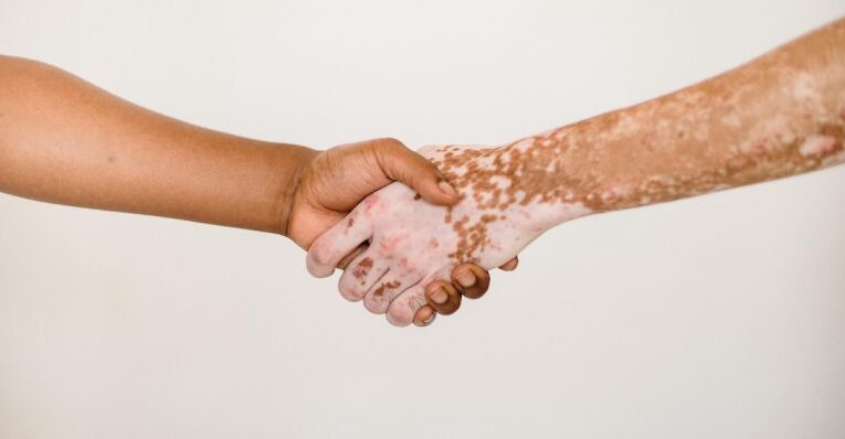 VITILIGO PROVOCA BAJA AUTOESTIMA, ANSIEDAD O DEPRESIÓN