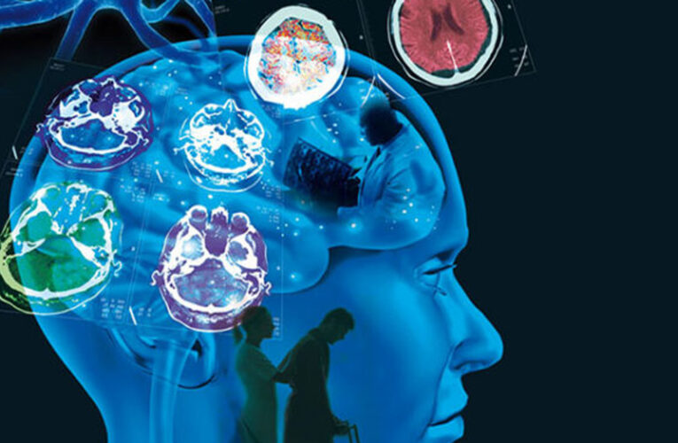 Test de sangre podría detectar Esclerosis Múltiple años antes de presentar síntomas.