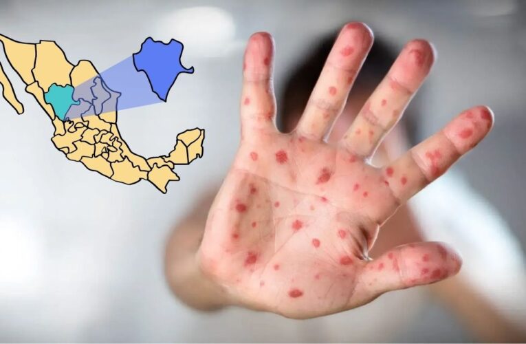 Reporta Durango 185 casos de sarampión; concentra brotes en capital y Mezquital