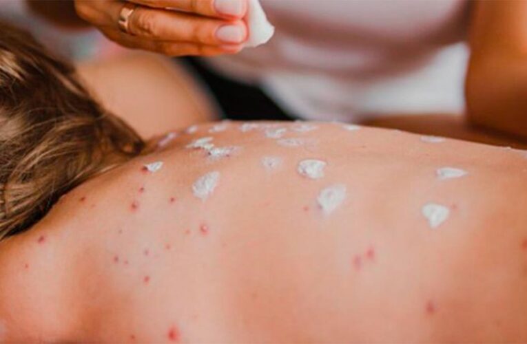 México registra 35 muertes por sarampión y primer fallecimiento asociado a miasis