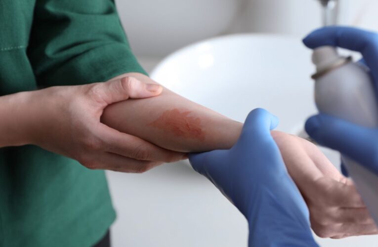 Científicos identifican mecanismo neuronal que vincula estrés con agravamiento del eccema